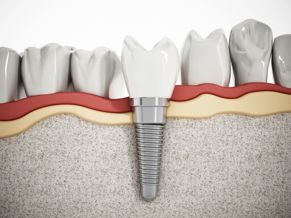 Dental implant diagram