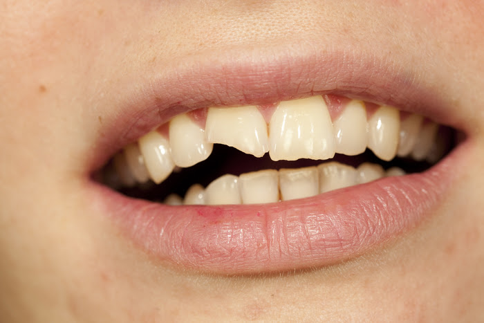 What Are Teeth Craze Lines? Treatment, Causes & Prevention - Tooth