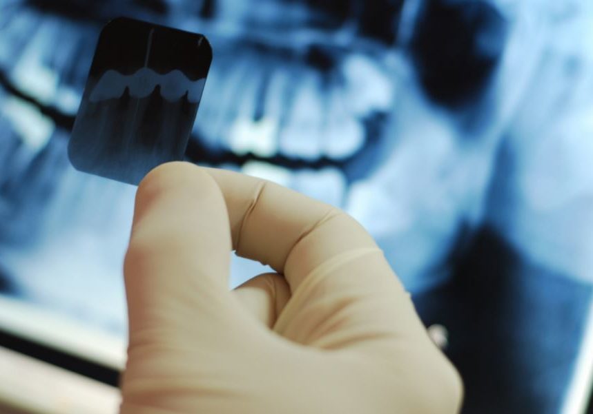 Dental-Xrays