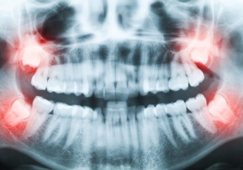 Closeup of x-ray image of teeth and mouth with all four molars v